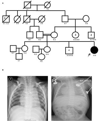 Novel MYO1D Missense Variant Identified Through Whole Exome Sequencing and Computational Biology Analysis Expands the Spectrum of Causal Genes of Laterality Defects